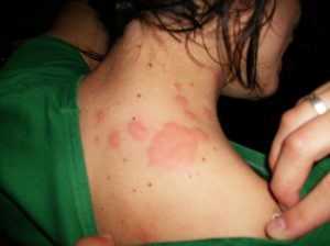 symptôme allergie punaise de lit