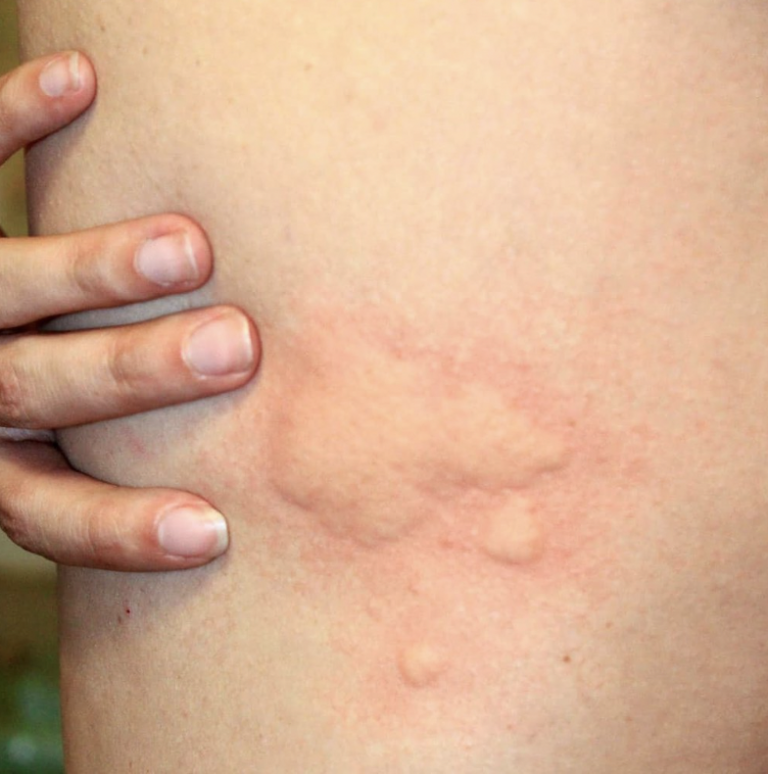 allergie punaise de lit : comment savoir ?